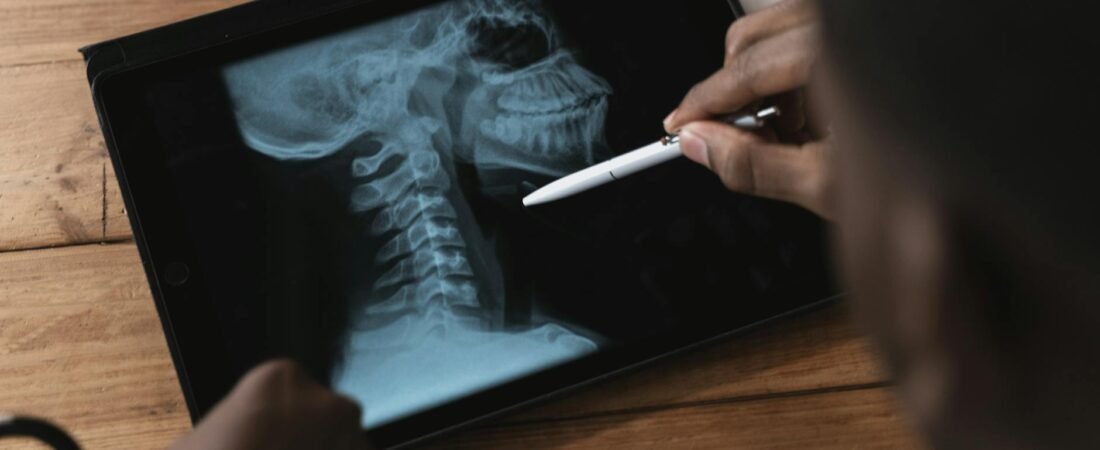 Huntington’s Disease